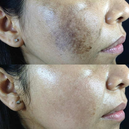 Plenora® – Crema anti manchas Coreana.